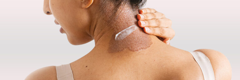Woman with psoriasis on her neck