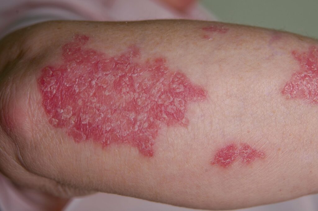 Plaque psoriasis on an arm with white skin