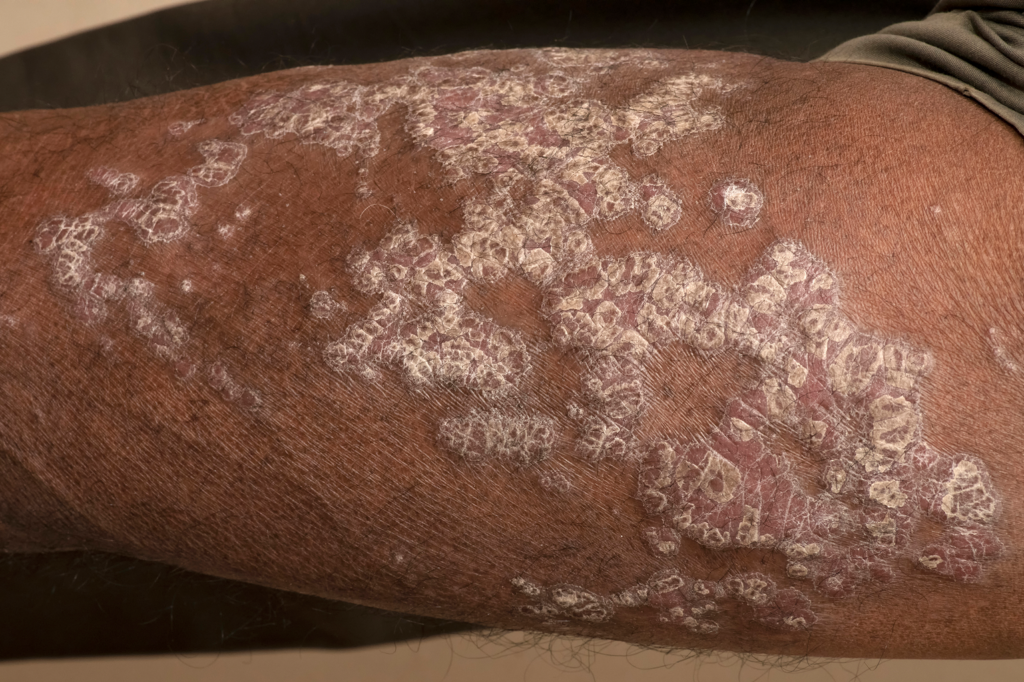 Plaque psoriasis on an arm with black skin