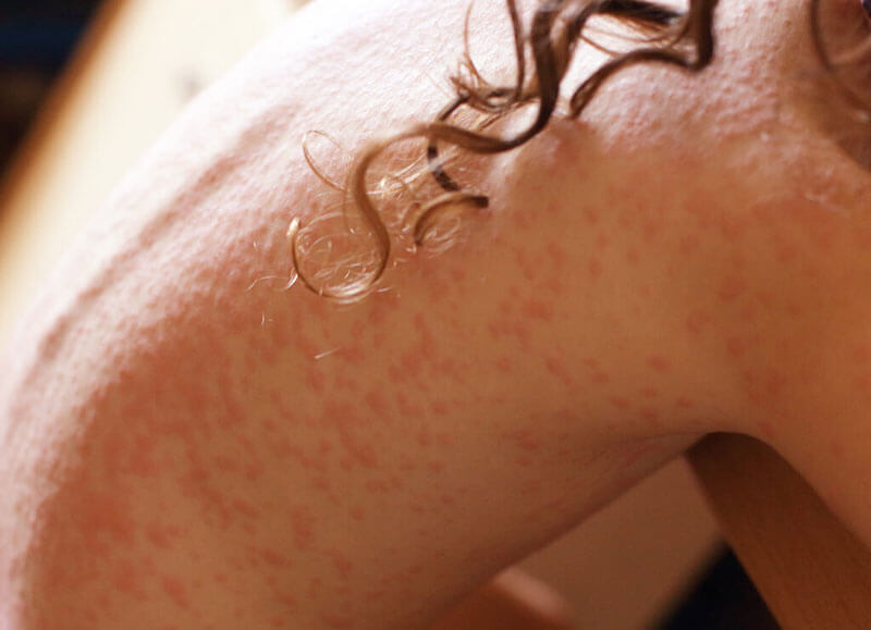 psoriasis