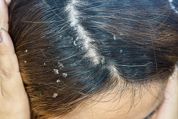 Seborrheic Dermatitis or Dandruff