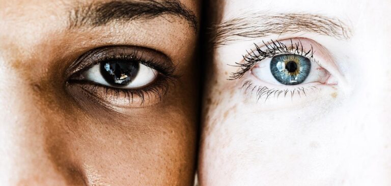 pigmentation