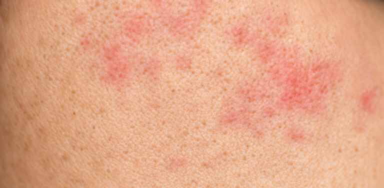 contact-dermatitis