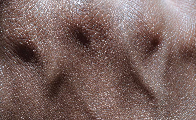background-Ichtyosis