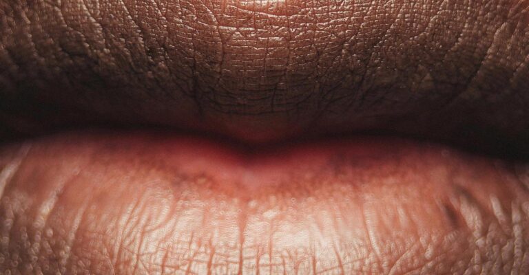 dry-mouth