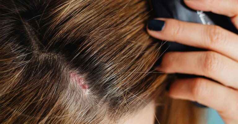 scalp-eczema