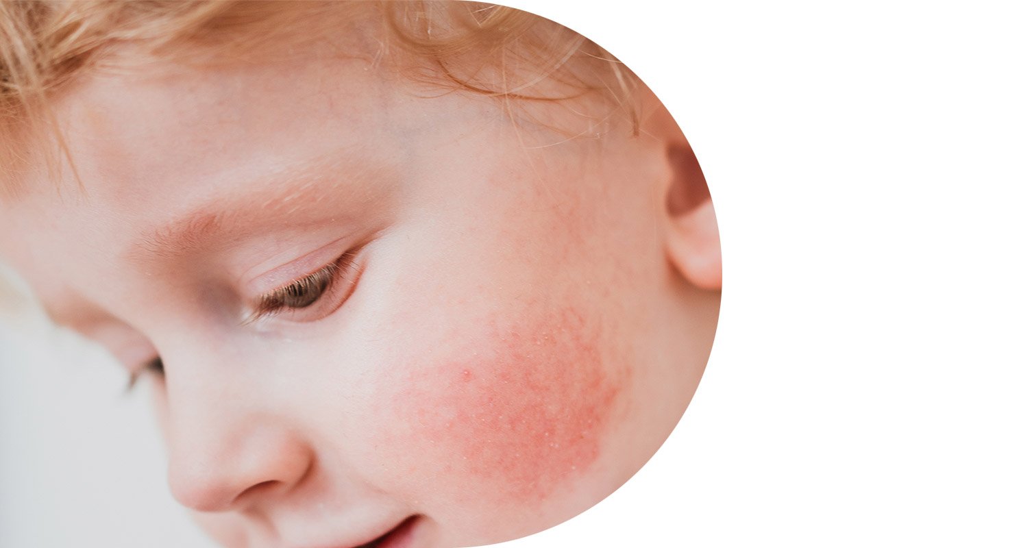 product-selector-child-dermatitis