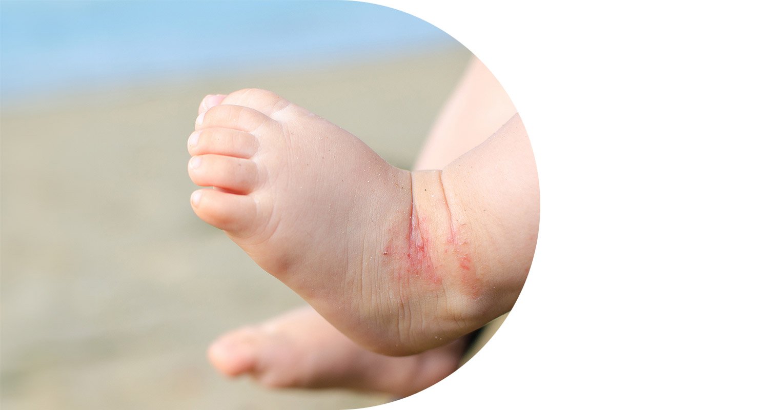 product-selector-child-eczema