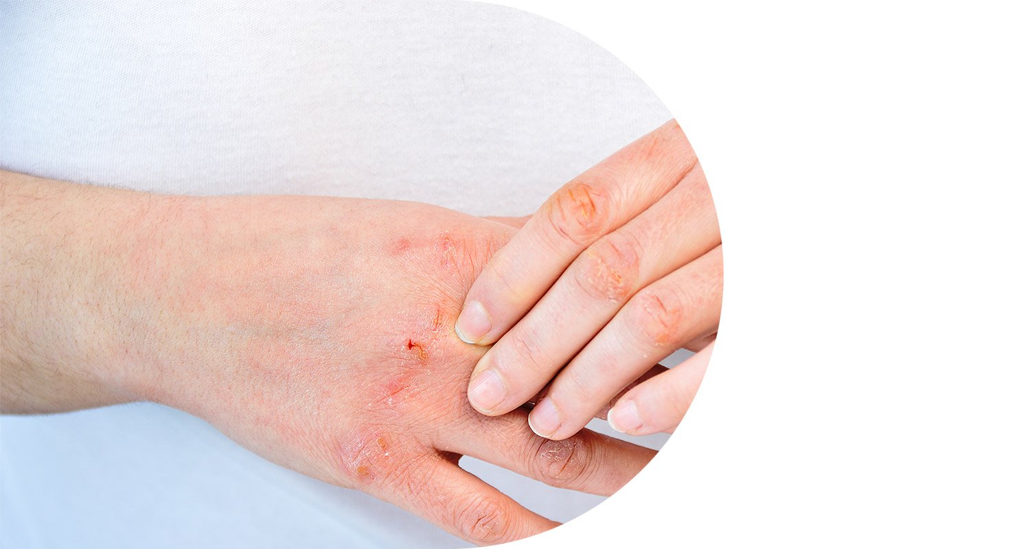 product-selector-eczema