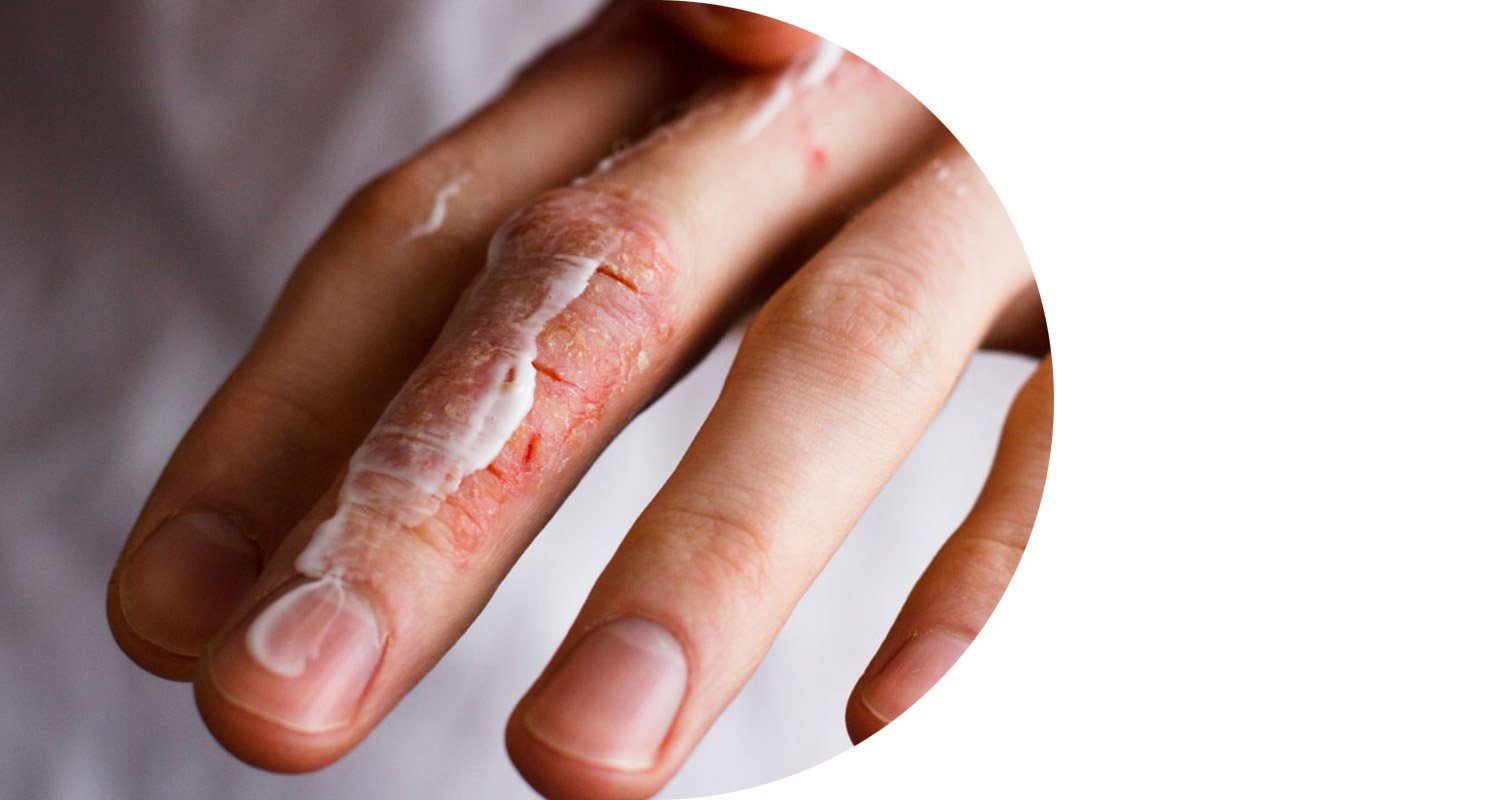 eczema