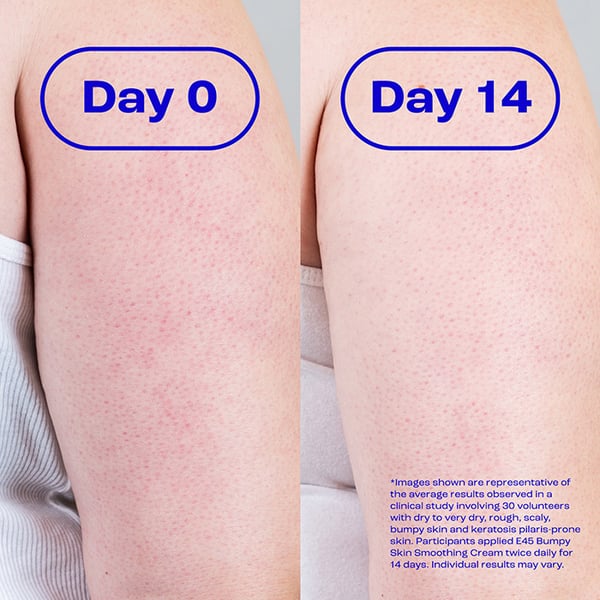 E45-Bumpy-Skin-100g-PDP_v2_6-Comparison
